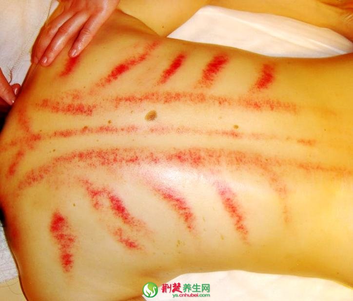 <a href=http://www.daocaipu.com/yangsheng/ target=_blank class=infotextkey>養生</a>常識 為什麼有人刮不出痧