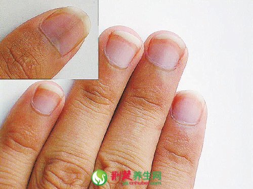 指甲紋理中有橫豎紋是什麼原因