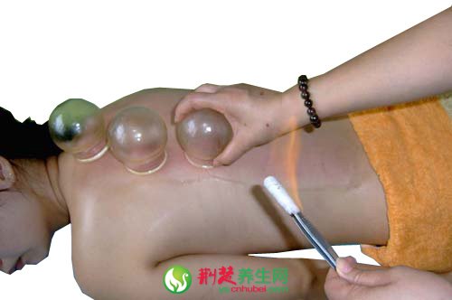 拔罐治療夏季吹空調受涼